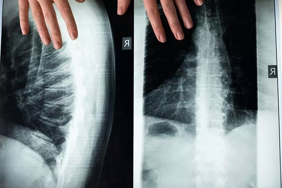 x-ray of spinal column